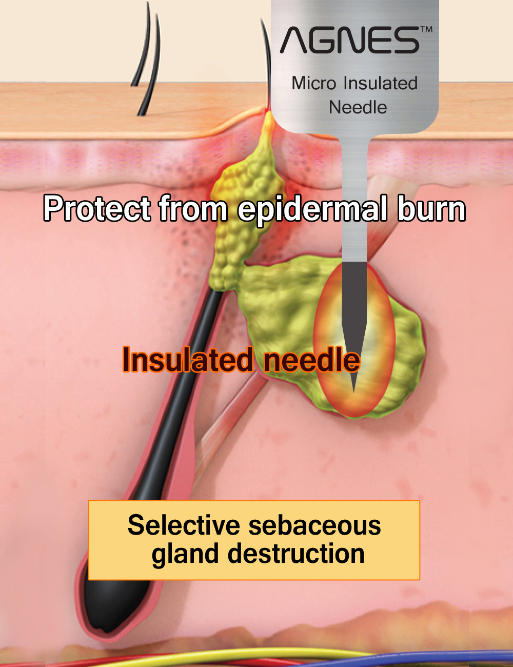 Selective sebaceous gland destruction