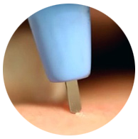 アグネスによるイボ治療の施術風景