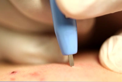 アグネスによるイボ治療の施術風景