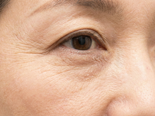 なるべく痛みの少ないニキビ治療が受けたい方