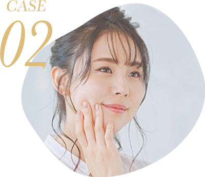 HIFUによる表情筋層へのリフトアップ